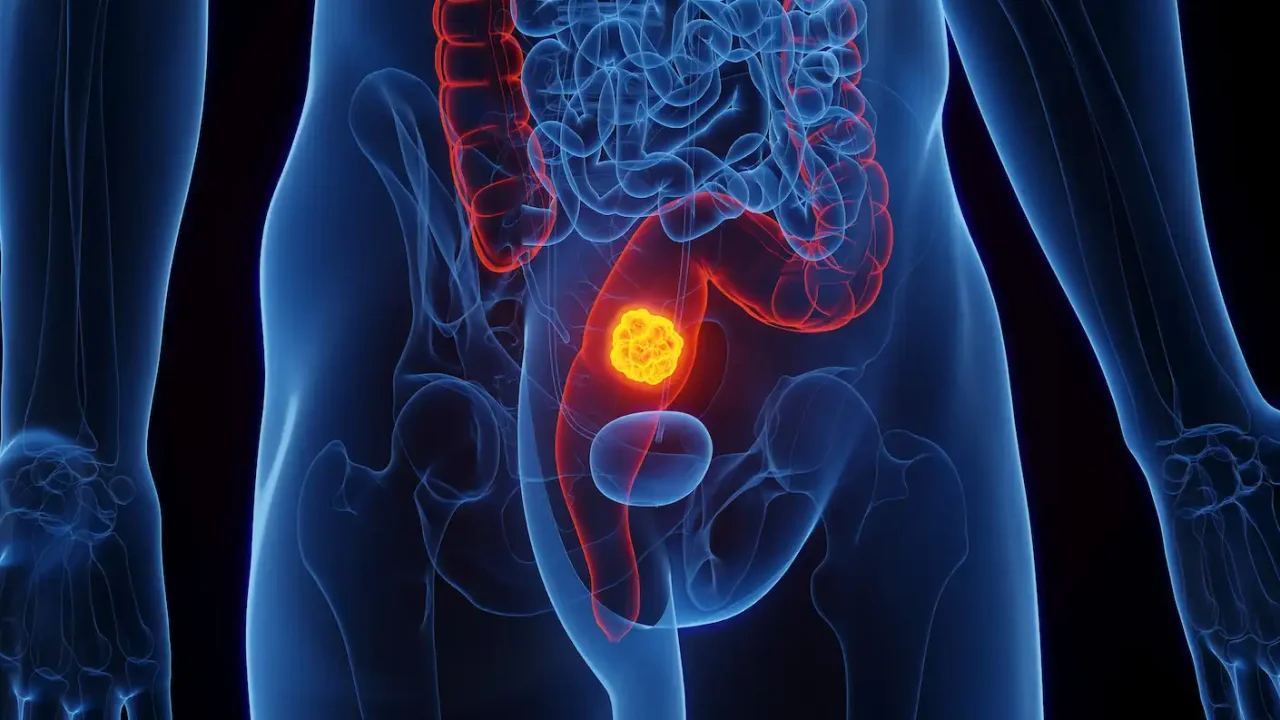 Why Doctors Say Rectal Cancer Location Changes Everything About Your Treatment
